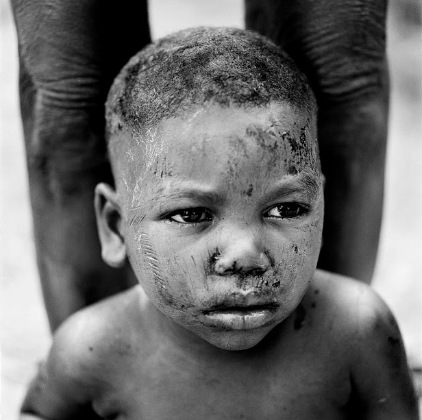 Khuôn mặt đứa trẻ đã lành sẹo sau khi thực hiện xong nghi lễ rạch mặt.