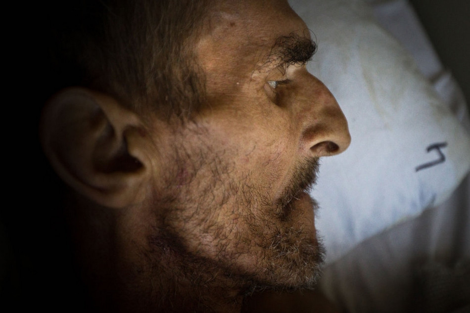 Khuôn mặt hốc hác, khô gầy của một bệnh nhân lao.