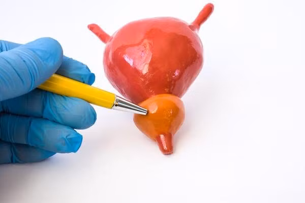 4 nhom quy ong can de phong ung thu tuyen tien liet ghe tham