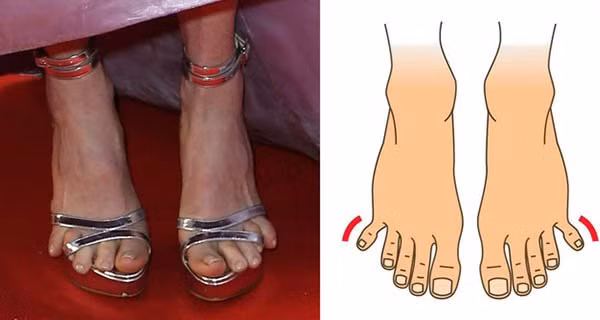 Nhin do dai ngon chan biet ngay van menh tuong lai giau co hay ban han