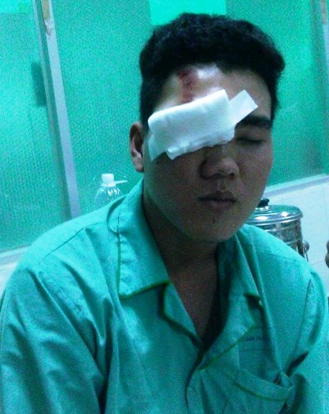 Nạn nhân Lê Thanh Hải có khả năng bị mù mắt phải, hiện mắt trái cũng bị ảnh hưởng. Ảnh: Phan Cường