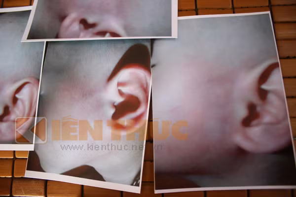 Hình ảnh cháu Nguyễn Thị Lan Anh bị cô giáo đánh tím tái mặt, tai trái. Hình ảnh cháu Nguyễn Thị Lan Anh bị cô giáo đánh tím tái mặt, tai trái.