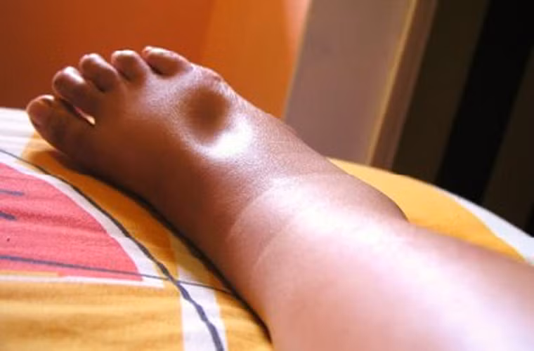 Phù: Thường gặp phù mắt cá chân do các bệnh lý tim mạch. Cần đưa người bệnh đi khám để xác định nguyên nhân gây ra phù chân.