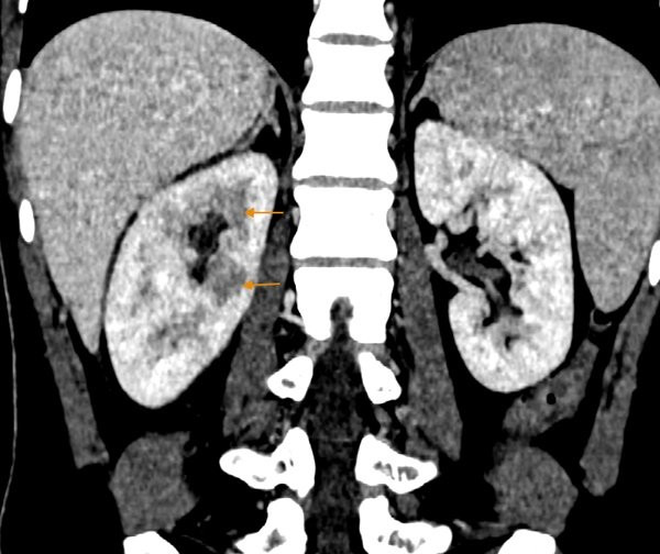 1 thoi quen de mac o nguoi Viet co the gay suy, hong than