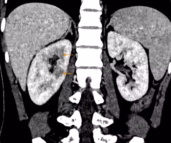 1 thoi quen de mac o nguoi Viet co the gay suy, hong than