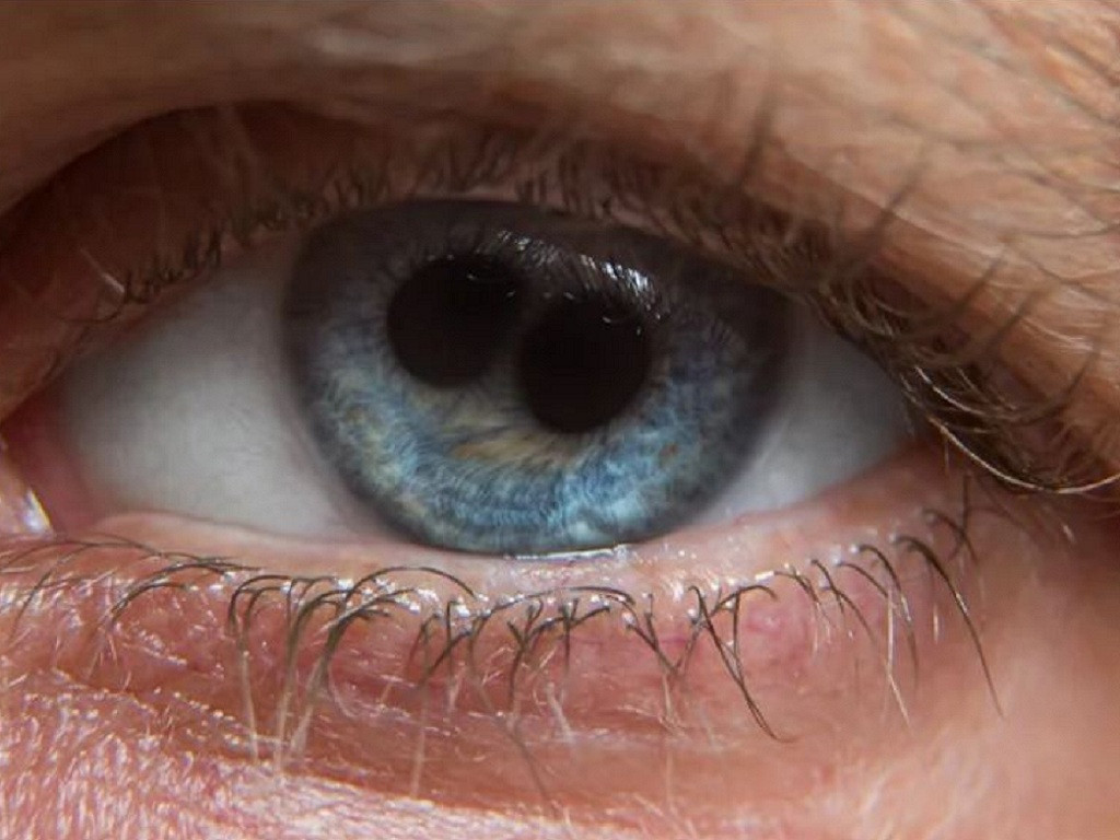 Với người xưa đây được xem là một quý tướng, ai có hai đồng tử trong mắt sẽ là người mang đến điềm lành cho đất nước, nhưng giới y học ngày nay gọi nó là căn bệnh đồng tử kép. Đây thực chất là một dị tật bẩm sinh khá nguy hiểm. Dị tật xuất hiện do mống mắt người có vấn đề, đồng tử hình tròn bị biến dạng thành hình ∞.