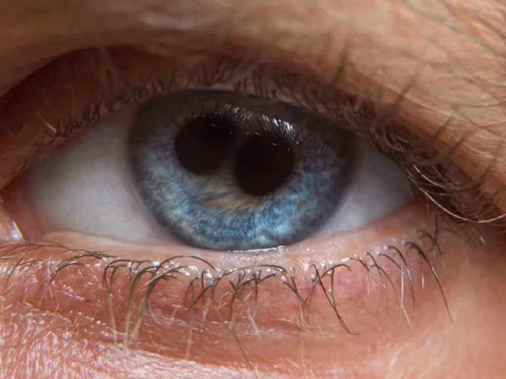 Với người xưa đây được xem là một quý tướng, ai có hai đồng tử trong mắt sẽ là người mang đến điềm lành cho đất nước, nhưng giới y học ngày nay gọi nó là căn bệnh đồng tử kép. Đây thực chất là một dị tật bẩm sinh khá nguy hiểm. Dị tật xuất hiện do mống mắt người có vấn đề, đồng tử hình tròn bị biến dạng thành hình ∞.