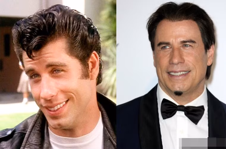Khuôn mặt của John Travolta cũng thay đổi nhiều so với thời đóng "Saturday Night Fever" và "Grease". Có tin đồn, John đã tiêm Botox nên khuôn mặt anh giờ trông rất đơ, to hơn và vô cảm.