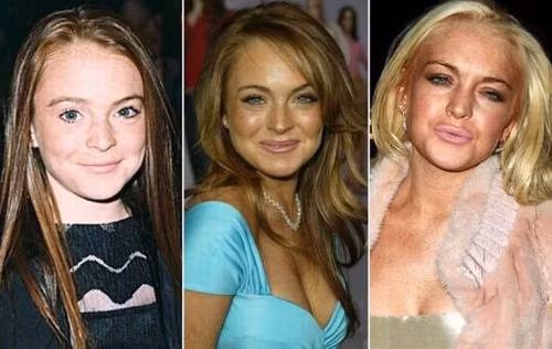 Từng là ngôi sao nhí vạn người mê sau thành công của bộ phim "Parent Trap", nhưng Lindsay Lohan cứ trượt dốc không phanh và là một trong những ngôi sao sớm bị thất sủng ở Hollywood bởi lối sống ra tù vào tội, nghiện ngập. Hậu quả kéo theo là nhan sắc và sự nghiệp của cô ngày càng thảm hại.