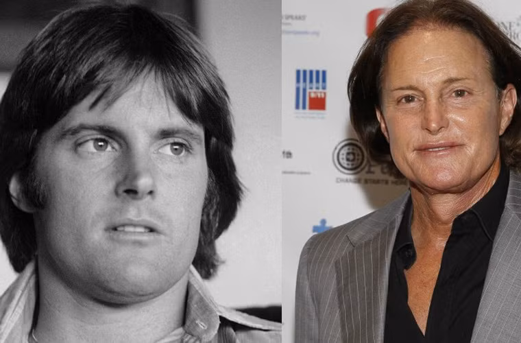 Từng là một vận động viên đoạt huy chương vàng Olympic năm 1976, rồi sau đó trở thành ngôi sao truyền hình thực tế với vai trò là bố dượng của Kim Kardashian trong Keeping Up With The Kardashian, ngoại hình của Bruce Jenner thay đổi ghê gớm sau nhiều lần phẫu thuật thẩm mỹ.