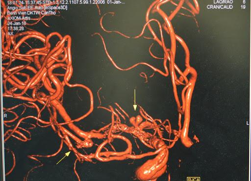 Doi dien voi nguy co vo dong mach nao do dau dinh dau lien tuc-Hinh-3