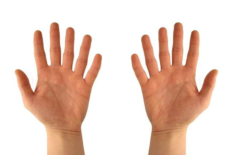 Sinh ra thừa 1 ngón tay hoặc 1 ngón chân: Hầu hết mọi người đều sinh ra có mỗi bàn tay và mỗi bàn chân 5 ngón, song hiện tượng thừa ngón cũng không phải là hiếm. Theo Viện Boston Children’s Hospital, cứ khoảng 500 - 1.000 trẻ sinh ra thì lại có 1 em bé bị thừa 1 ngón tay hoặc 1 ngón chân.