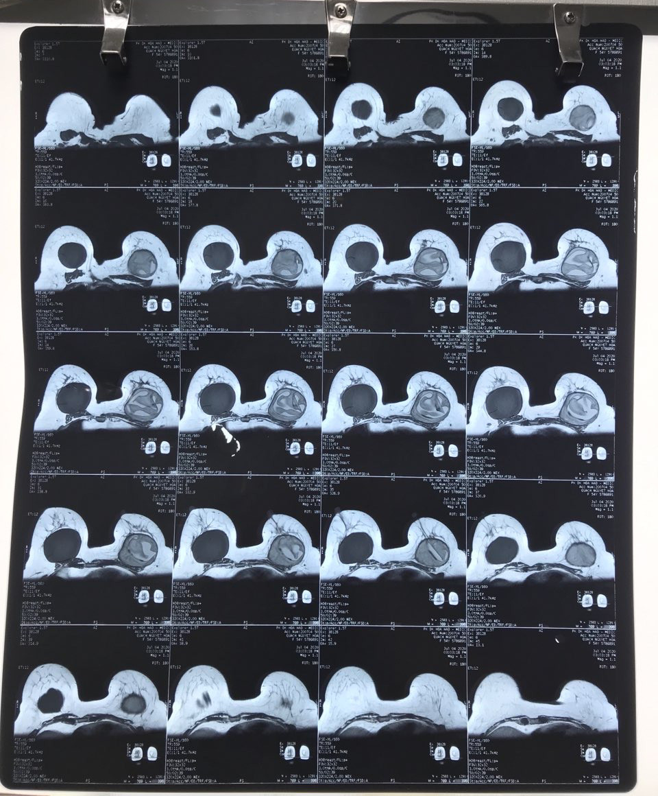 Dat tui nguc dom, nguoi phu nu dau don vi nguc vo, bien dang