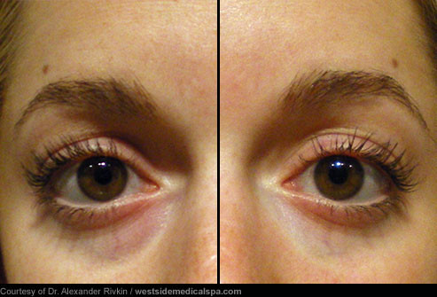 Trước và sau khi dùng chất độn thẩm mỹ cho vùng quầng thâm mắt: Chất độn cũng có thể che khuất hình ảnh mệt mỏi, bọng túi và quầng thâm dưới mắt. Bằng cách làm đầy các khu vực rỗng xung quanh hốc mắt, liệu pháp này làm giảm quầng tối, bọng mắt và mắt trũng sâu.