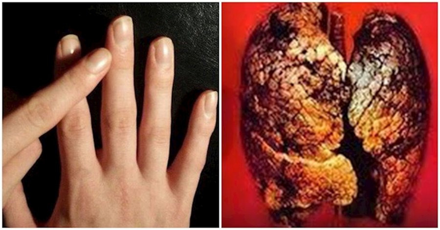 Nhìn 4 điểm phình to ở ngón tay biết ngay K phổi Nhin 4 diem phinh to o ngon tay biet ngay K phoi