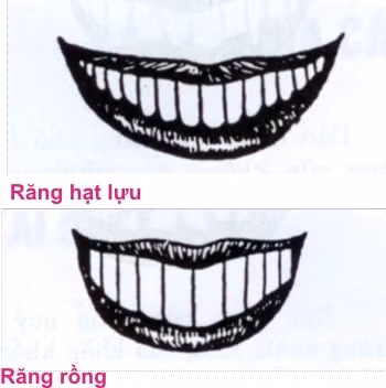Răng thưa khó giữ của, răng cửa to vận khí hơn người Rang thua kho giu cua, rang cua to van khi hon nguoi