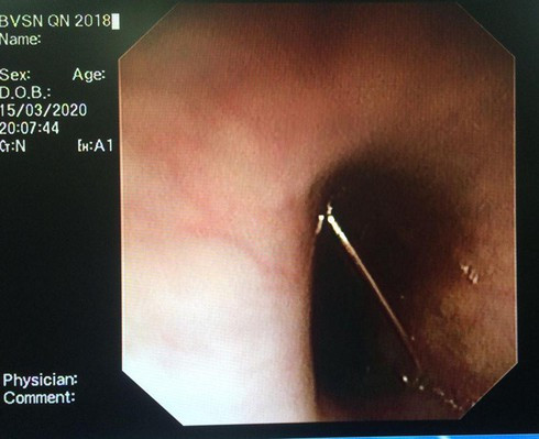 Hoang hon be 4 tuoi nuot kim bang, bi dau nhon cam vao thuc quan