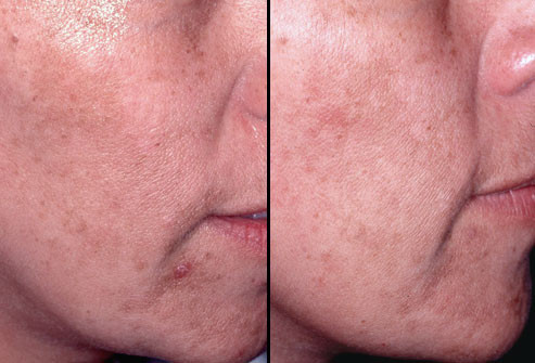 Trước và sau đắp mặt nạ hóa chất: Đắp mặt nạ nhiều lần có thể làm giảm các đốm đồi mồi, nếp nhăn xung quanh miệng và mắt, vết sẹo mụn trứng cá và nếp nhăn do ánh nắng mặt trời hoặc lão hóa. Sự lột nhẹ da mặt, như hình trên, có kết quả rõ rệt hơn. Có thể đắp mặt nạ vài tuần/ lần đến khi đạt hiệu quả mong muốn.