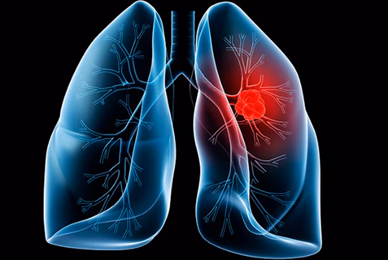 Một nghiên cứu được thực hiện bởi Hiệp hội Hóa học Mỹ cũng chỉ ra, lượng apigenin, hesperidin, limonin, naringin, naringenin và nobiletin trong bưởi góp phần tiêu diệt tế bào ung thư, kích thích sự hình thành các tế bào khỏe mạnh ở ruột. Đặc biệt, mỗi ngày dùng 3 ly, mỗi ly khoảng 170g nước ép bưởi mang lại khả năng đẩy lùi tác hại của khói thuốc lá và xì gà, ngừa ung thư phổi hiệu quả.