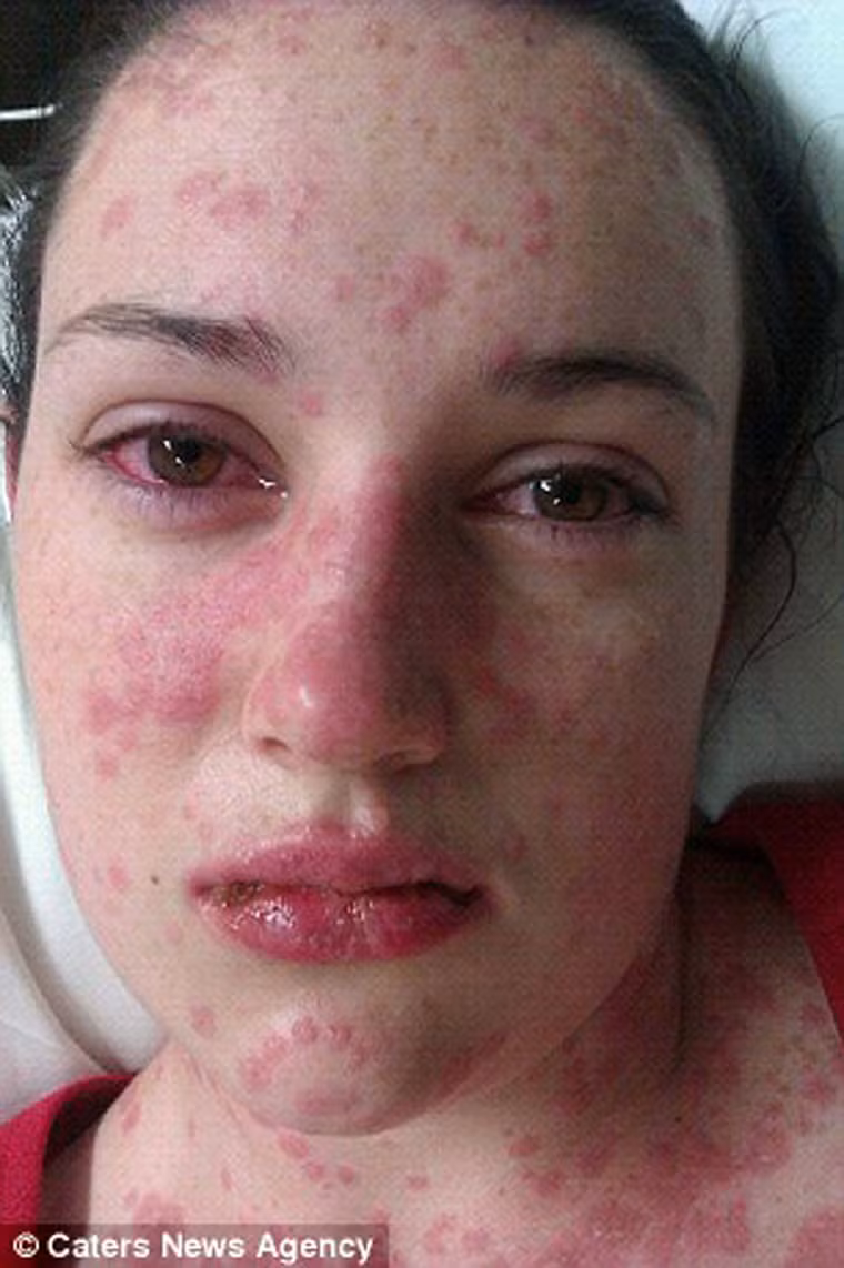 Những vết phát ban nhỏ trên ngực cũng nhanh chóng lan khắp. Tại một bệnh viện ở Sydney, các bác sĩ cho biết cô bị mụn rộp và cho phép về nhà điều trị.