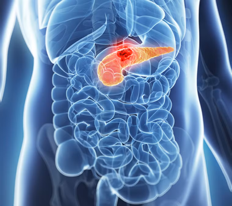 Ung thư tuyến tụy. So với các loại ung thư khác, ung thư tuyến tụy có tốc độ phát triển nhanh nhất. Đặc biệt, bệnh khó được phát hiện sớm bởi hiện chưa có phương pháp chẩn bệnh hữu hiệu nào. Tỷ lệ sống của bệnh nhân ung thư tuyến tụy 1 năm đạt 25%. Sau năm năm, chỉ còn mức 6%.