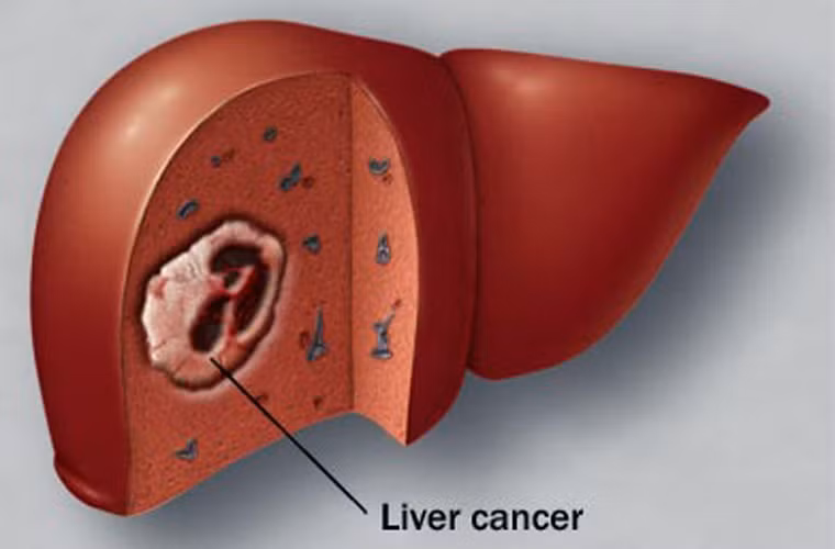 Ung thư gan trở thành kẻ giết người số 1 bởi nó không có triệu chứng nhận diện đặc hiệu. Hầu hết những trường mắc bệnh được phát hiện khi tế bào ung thư đã di căn khắp cơ thể, khó lòng cứu vãn.