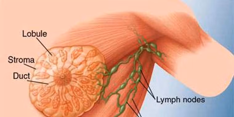 Ung thư vú. So với nam giới, ung thư vú được chẩn đoán ở phụ nữ cao hơn gấp 100 lần. Nó cũng được đánh giá là loại ung thư gây tử vong nhiều thứ hai ở phụ nữ - chỉ sau ung thư phổi. Trên thế giới, ung thư vú chiếm khoảng 29% các ca ung thư được chẩn đoán. Đặc biệt, phụ nữ ở các nước đang phát triển có khả năng mắc bệnh cao hơn so với nước phát triển. Theo NCI, năm 2010 có gần 40.000 người chết vì ung thư vú.
