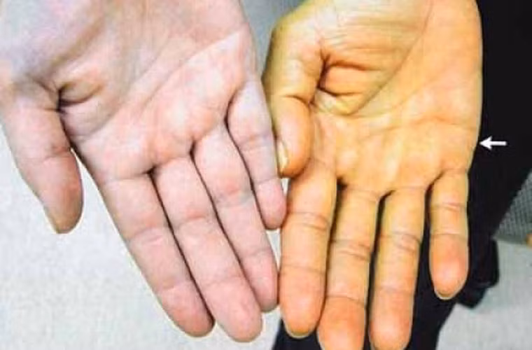 Vàng da. Một trong những biểu hiện không nên bỏ qua của ung thư gan là tình trạng vàng da bất thường. Giống như trên, nguyên nhân gây vàng da bắt nguồn do chức năng gan suy giảm, lượng bilirubin trong máu tăng.