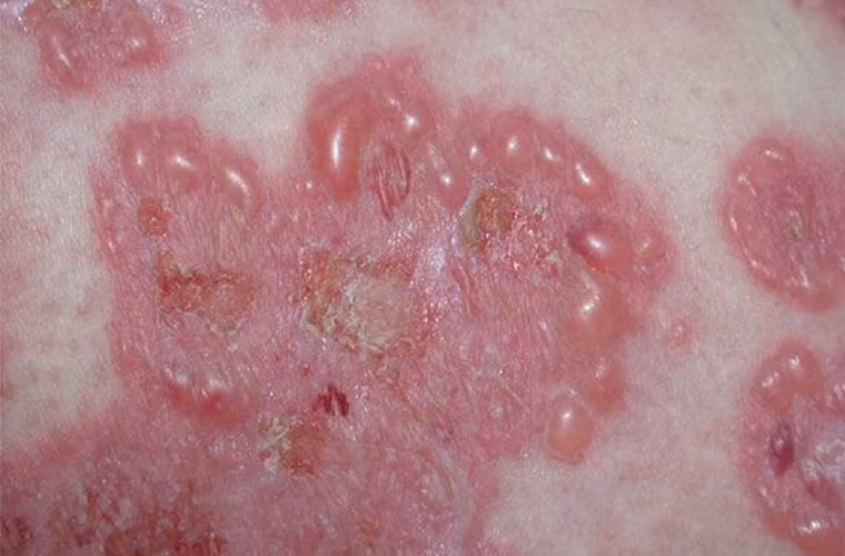 Hoại tử thượng bì nhiễm độc không có cách ngăn ngừa cũng như không có phương pháp chữa trị hữu hiệu. Bệnh nhân thường được chăm sóc giống người bị phỏng, dùng thuốc giảm đau và thay thế hóa chất.