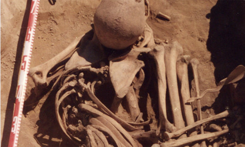 Đây được xem là bộ xương bệnh nhân ung thư lâu đời nhất từng được phát hiện.