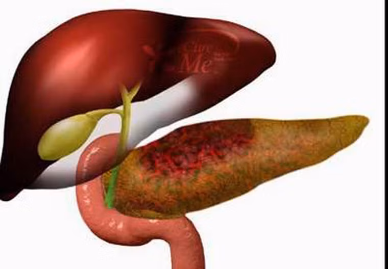 Ung thư tuyến tụy. So với các loại ung thư khác, ung thư tuyến tụy có tốc độ phát triển nhanh nhất. Đặc biệt, căn bệnh khó có thể phát hiện sớm bởi hiện chưa có phương pháp chẩn bệnh hữu hiệu nào. Tỷ lệ sống của bệnh nhân ung thư tuyến tụy 1 năm đạt 25%. Sau năm năm, tỷ lệ này chỉ còn mức 6%.