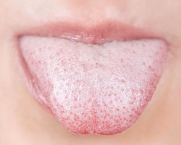 Nếu lưỡi phủ lớp bợn trắng dày, có thể bạn đang có vấn đề về gan và túi mật.