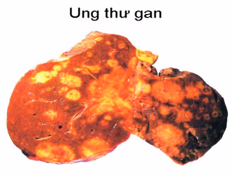 Gan có xu hướng phình to.