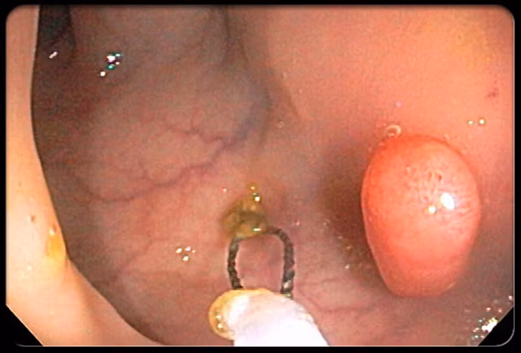 Ung thư đại tràng. Ung thư đại tràng là căn bệnh gây ra lượng người tử vong lớn thứ ba ở cả nam giới và phụ nữ. Nhìn chung, bệnh thường bắt nguồn từ tế bào lành tính (polyp).