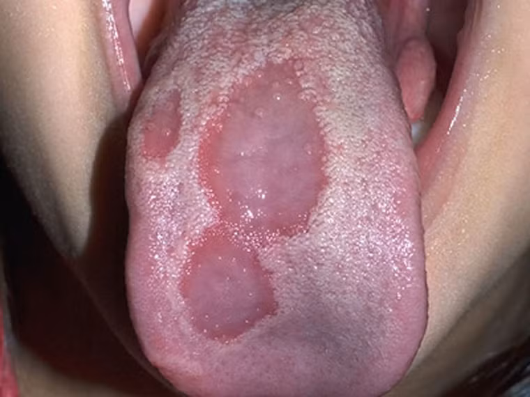 Khi trên lưỡi có những vết như hình bản đồ, viền màu trắng, phía trong đỏ đậm hơn màu lưỡi bình thường và dần dần loang rộng ra, rất có thể bạn bị viêm lưỡi bản đồ. Hiện chưa rõ nguyên nhân chính xác gây nên tình trạng trên. Tuy nhiên bệnh tiểu đường, căng thẳng, dị ứng và sử dụng thuốc tránh thai loại uống là một số lý do.