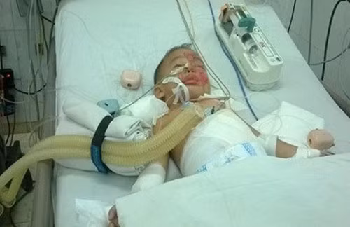 Cháu Hóa đang thở máy, hôn mê tại BV Nhi đồng tỉnh Đồng Nai.