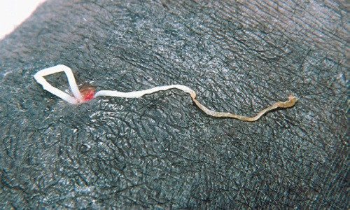 Hình ảnh ghê rợn cho thấy con giun ký sinh bị kéo ra khỏi da của người nhiễm giun chỉ Dracunculiasis.