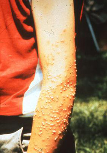 Kiến lửa (Solenopsis). Kiến lửa thường đốt và truyền chất độc vào người nạn nhân. Bình thường thì lượng chất độc này không đủ gây ra tác hại nào cho con người. Tuy nhiên, với số lượng nhiều, và với những người bị dị ứng với chất độc của kiến lửa, loài vật này có thể giết chết người.