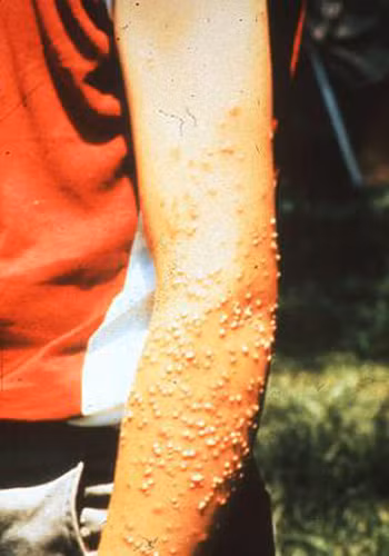 Kiến lửa (Solenopsis). Kiến lửa thường đốt và truyền chất độc vào người nạn nhân. Bình thường thì lượng chất độc này không đủ gây ra tác hại nào cho con người. Tuy nhiên, với số lượng nhiều, và với những người bị dị ứng với chất độc của kiến lửa, loài vật này có thể giết chết người.