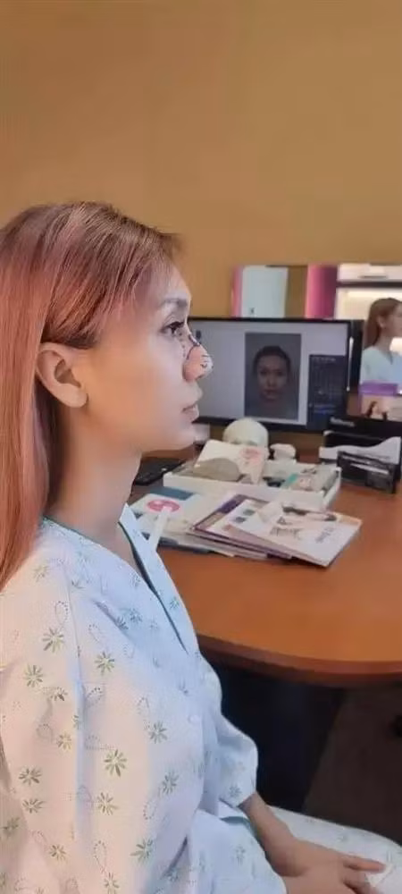 Chiếc mũi trước kia của Lynk Lee, vốn cao nhưng phần đầu mũi to và thô, chưa thực sự hài hòa với gương mặt.