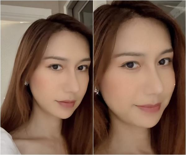 Chiếc mũi sau khi đã lành hẳn được nhận xét hài hòa với gương mặt hơn nhiều.