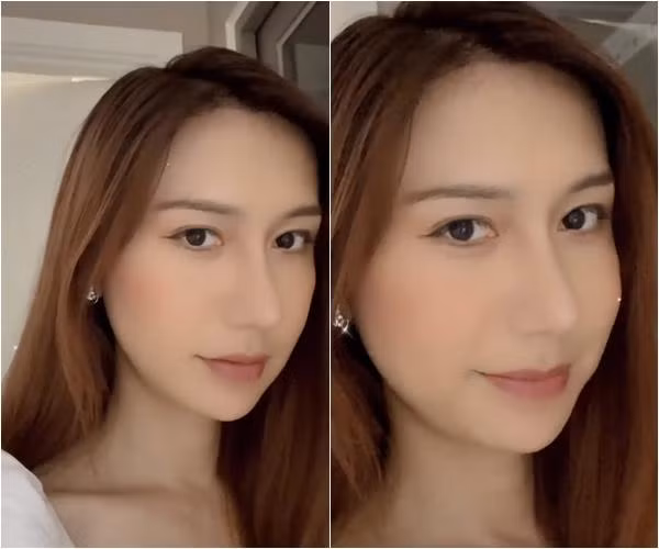 Chiếc mũi sau khi đã lành hẳn được nhận xét hài hòa với gương mặt hơn nhiều.