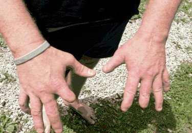 Sau 38 năm làm việc chiết xuất nọc rắn, hai bàn tay người đàn ông 55 tuổi này hiện đã chằng chịt các vết sẹo vì rắn cắn và độ dài của các ngón tay không còn nguyên vẹn nữa.