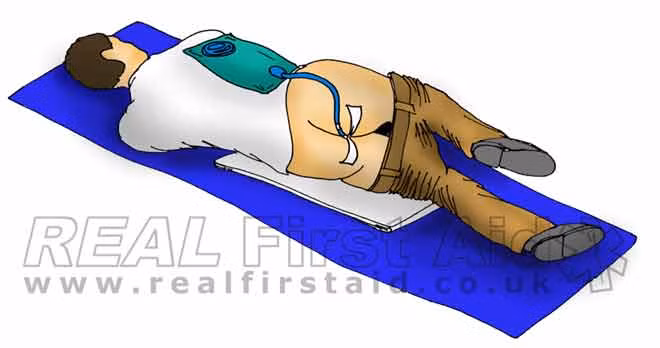 Ít nhất 5 nghi can trong các nhà tù của CIA bị tra tấn bằng biện pháp mang tên “Rectal feeding and rehydration”. Báo cáo chi tiết cho biết nghi phạm là những kẻ liên quan tới vụ đánh bom chiến hạm USS Cole của Mỹ. Họ bị đặt nằm ở tư thế đầu thấp hơn thân trước khi bị bơm chất lỏng ngược lên trực tràng qua đường hậu môn. Ảnh minh họa.