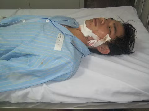 Nạn nhân bị thương trong vụ tai nạn lật xe.