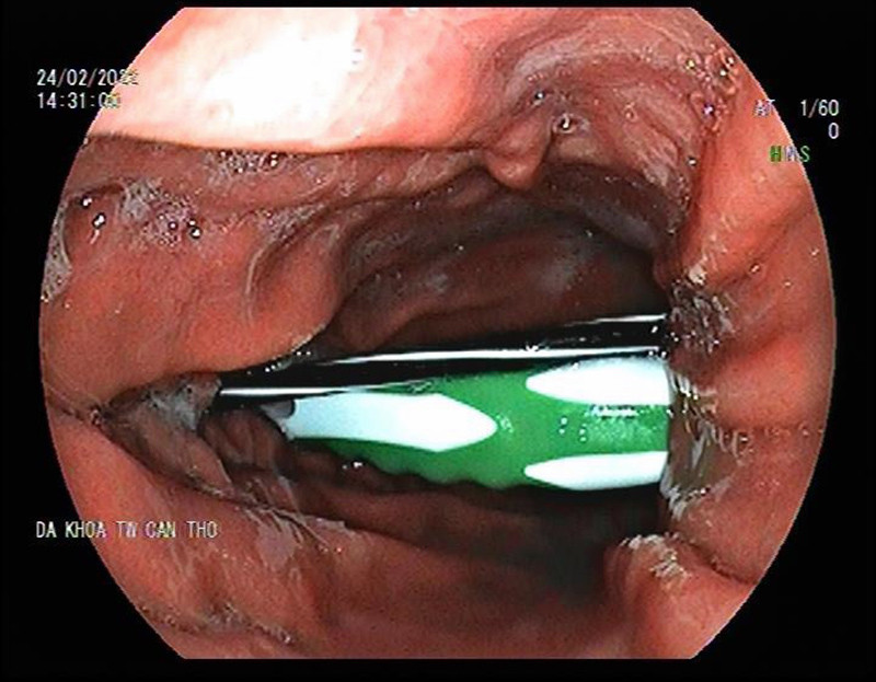 Bàn chải đánh răng, ruột bút bi trong dạ dày thanh niên 23 tuổi ảnh 1