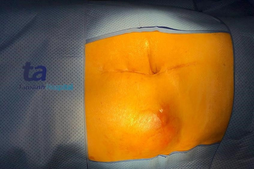 10 ngay xu ly khoi u lon, thoat vi ngoai thanh bung hiem gap