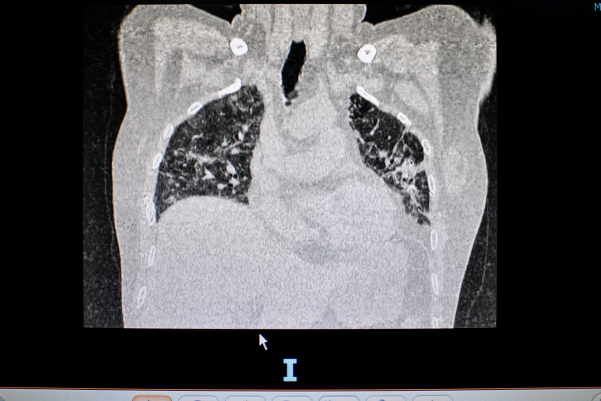 Dot quy, tho oxy sau khi khoi COVID-19-Hinh-2