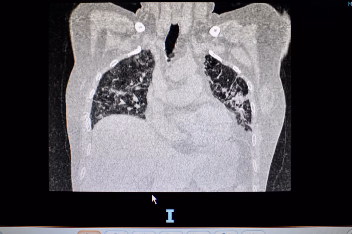 Dot quy, tho oxy sau khi khoi COVID-19-Hinh-2