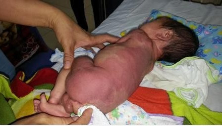 Những khối u máu do vị trí, kích thước, diễn biến phức tạp, có nguy cơ đe dọa tính mạng của trẻ, gây mất thẩm mỹ thì cần phải điều trị. Ảnh: Dantri